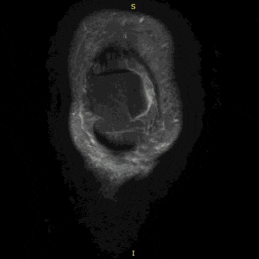 매봉역 한의원 | 무릎 바깥쪽 통증, 대퇴이두근건 장경인대 경비인대 문제일까요?
