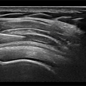 어깨 통증으로 팔 들기 힘들 때, 양재역 견우혈 지압으로 해결!