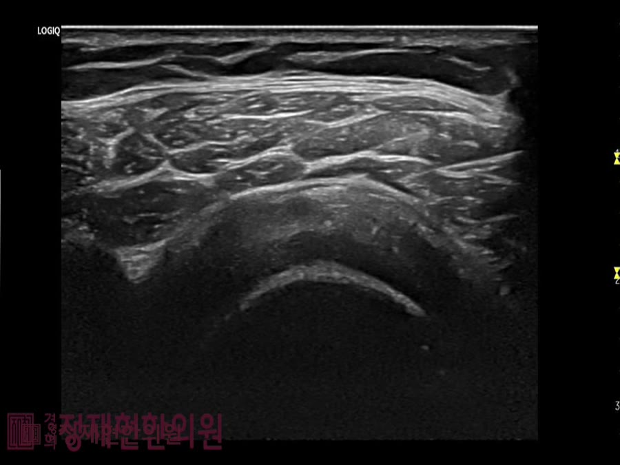 정재현한의원 도곡동 오십견 초음파약침 — 보면서 놓아야 정확합니다 사진 2