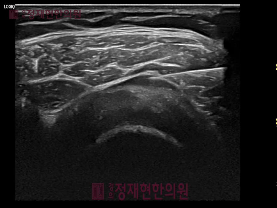 정재현한의원 도곡동 오십견 초음파약침 — 보면서 놓아야 정확합니다 사진 3