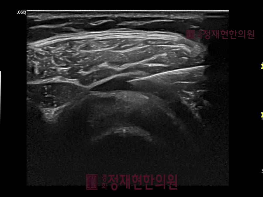 정재현한의원 도곡동 오십견 초음파약침 — 보면서 놓아야 정확합니다 사진 5