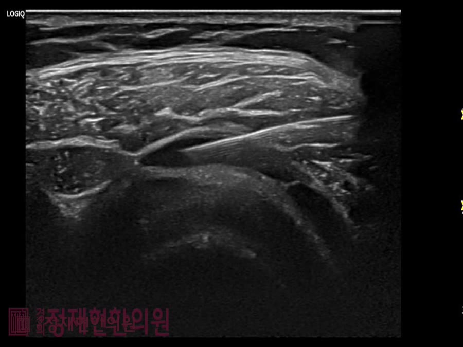 정재현한의원 도곡동 오십견 초음파약침 — 보면서 놓아야 정확합니다 사진 6